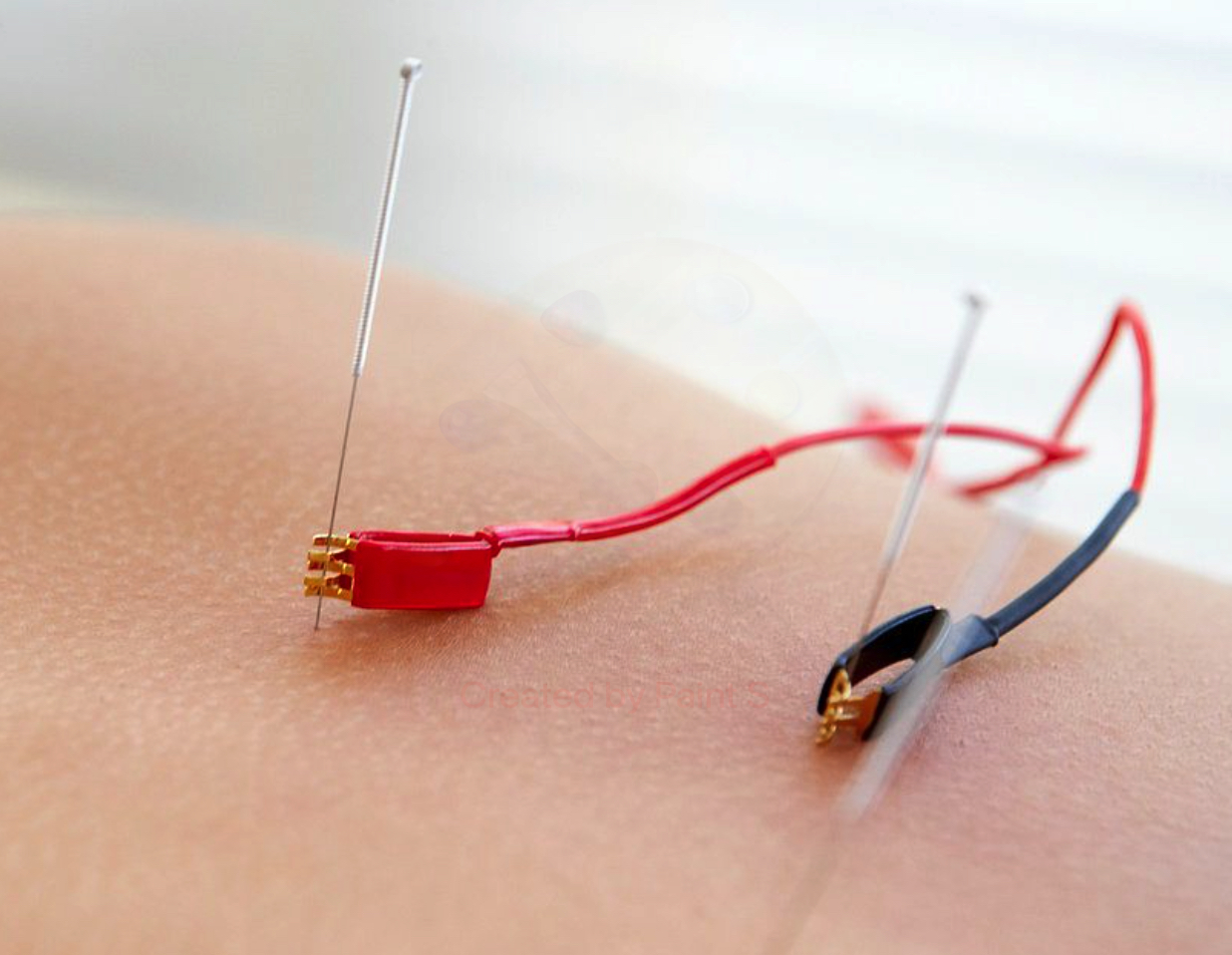 ELECTROACUPUNTURA ELECTROACUPUNTURA