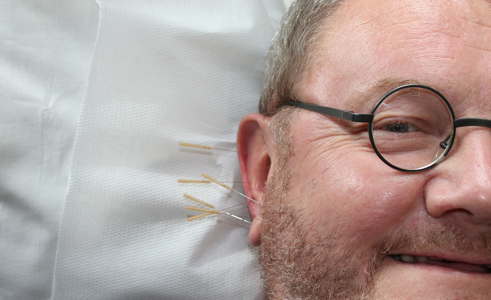 acupuncture-364613_1920